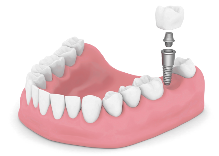 dental implant model Lafayette IN