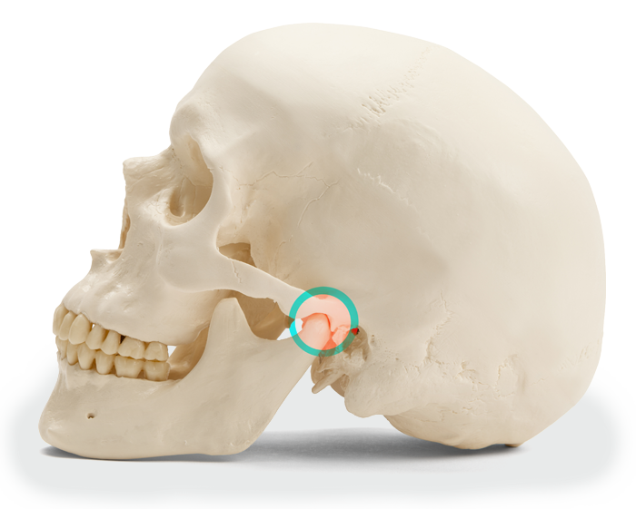 jaw bone model Lafayette IN