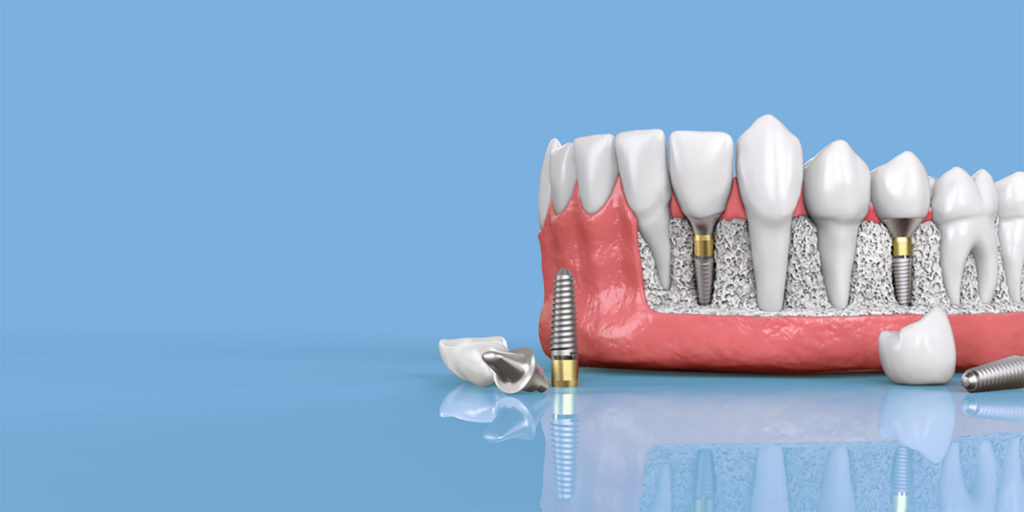 Dental Implants Metroplex Surgical Arts Dallas Waxahachie